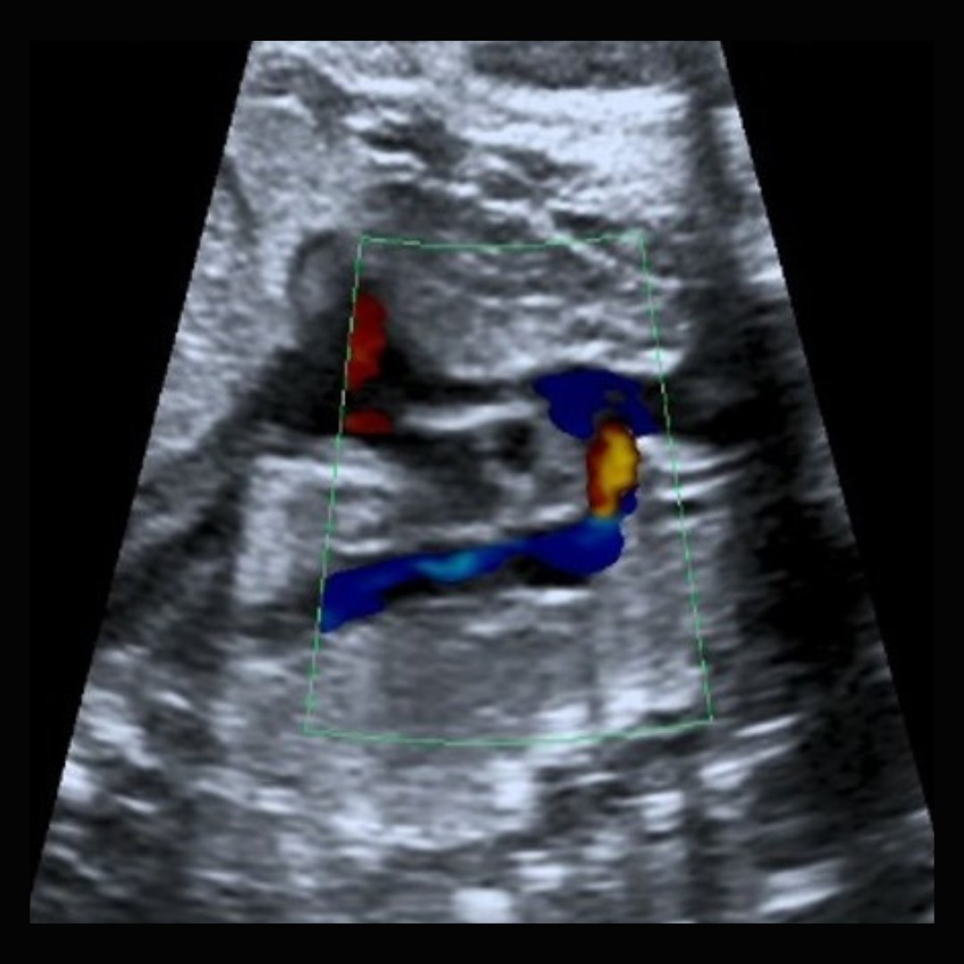 According to new #UOGJournal meta-analysis by Villalaín et al. prenatal ultrasound markers have poor diagnostic accuracy for predicting coarctation of the aorta postnatally. #freeaccess at bit.ly/3tNbKxX