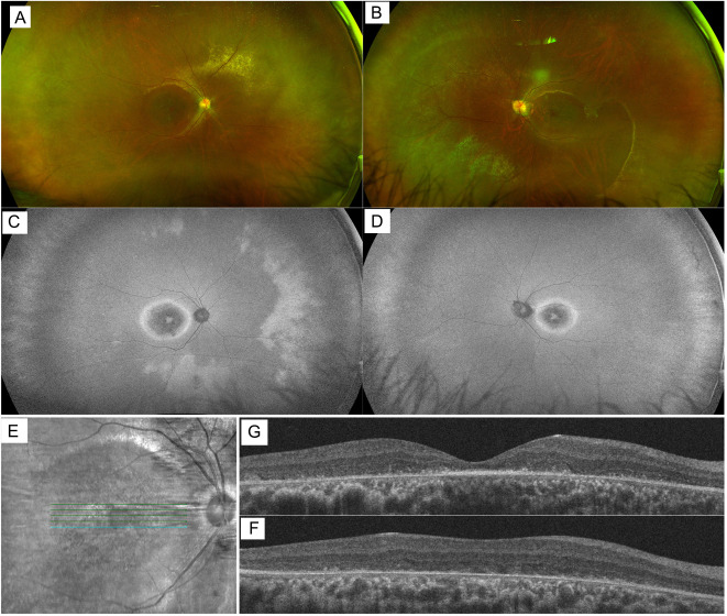 New publication alert! Dr. Brian Ballios' recent paper published on @CanJOphth describes a #retinal cone dystrophy featuring a unique tapetal-like sheen, caused by a novel RPGR #gene variant.

Read the full report &gt;&gt; bit.ly/3vD6ltJ