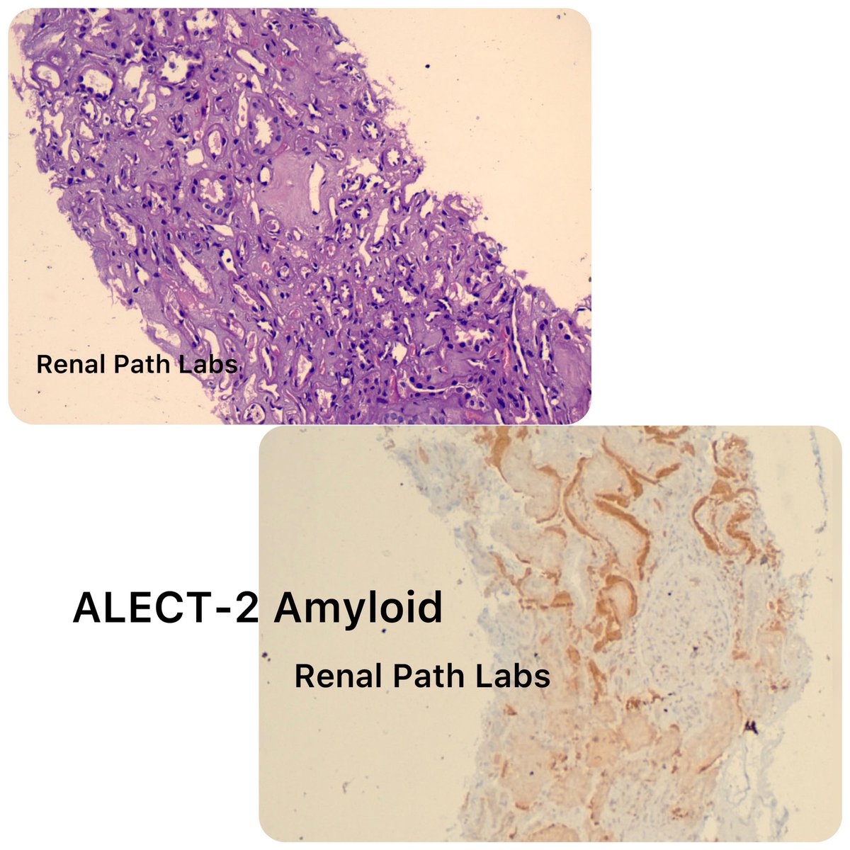 ALECT-2 Amyloid-Is it that rare in India??
Need to document each case!
May be missed easily!
#AskRenalPath #RenalPath #RenalPathScoiety #askRenal
#RareCase #Nephrologists
#LECT2Amyloid #PoojaMaheshwari