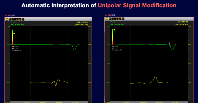 BioSig_Tech's tweet photo. PURE EP™'s Near Field Tracking (NFT) tracks the reduction in the negative component of a unipolar intracardiac signal — even during ablation — providing tissue-specific visualization of physiologic data. https://t.co/Q0RSsi1OlV #Electrophysiology #EPeeps #MedTech #Cardiology
