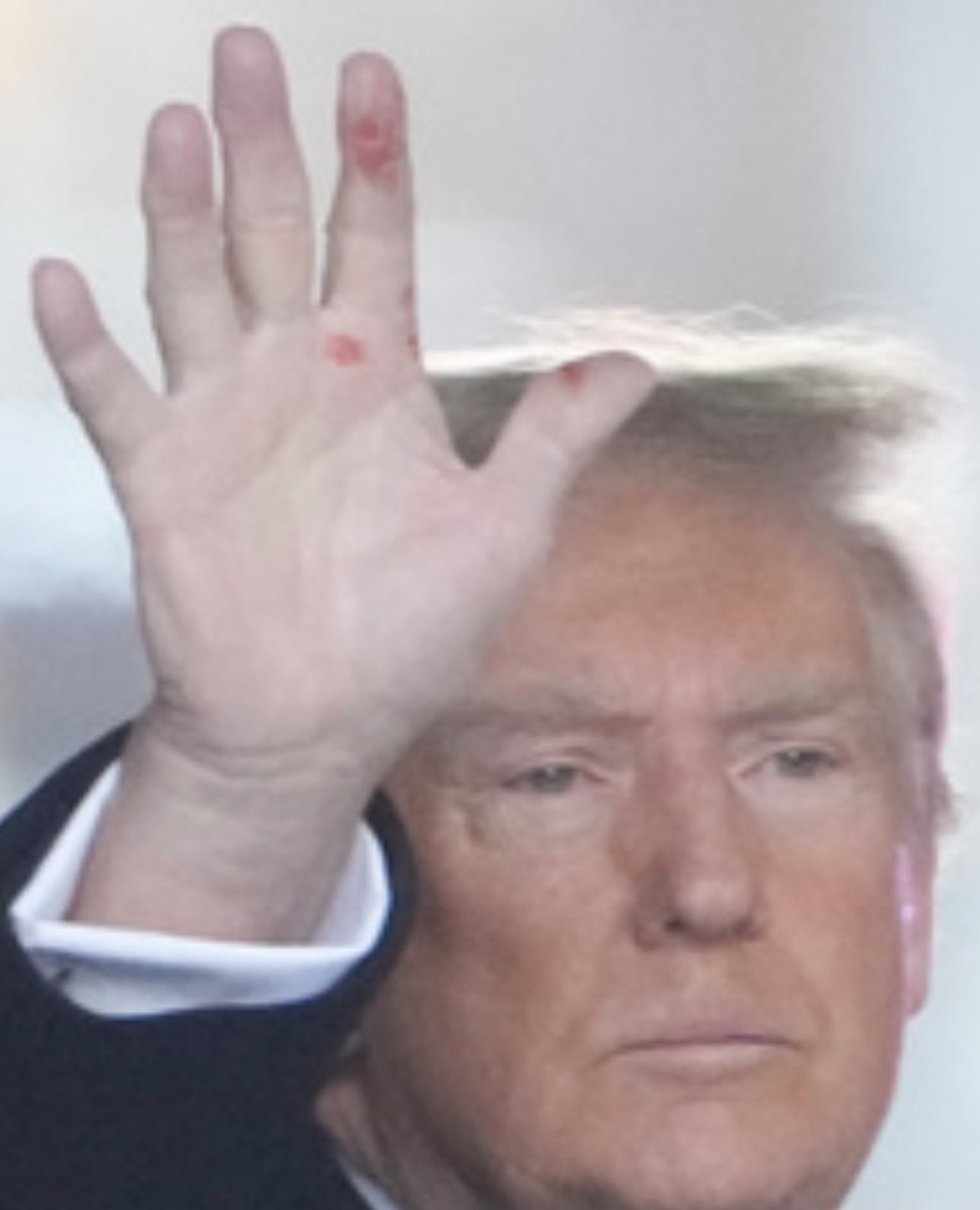 What happened to Trump’s hand? It wasn’t like this in New Hampshire.