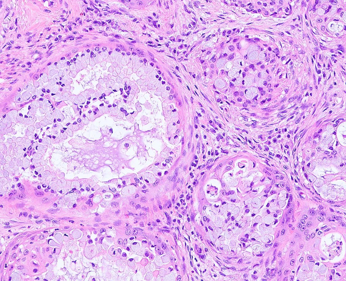 Mucoepidermoid carcinoma of the lung is a reminder that salivary glands can be found here too. It almost always has this heterogeneous look. #surgpath #pathX #pathtwitter #pathology #pathologists #cancer #lungcancer