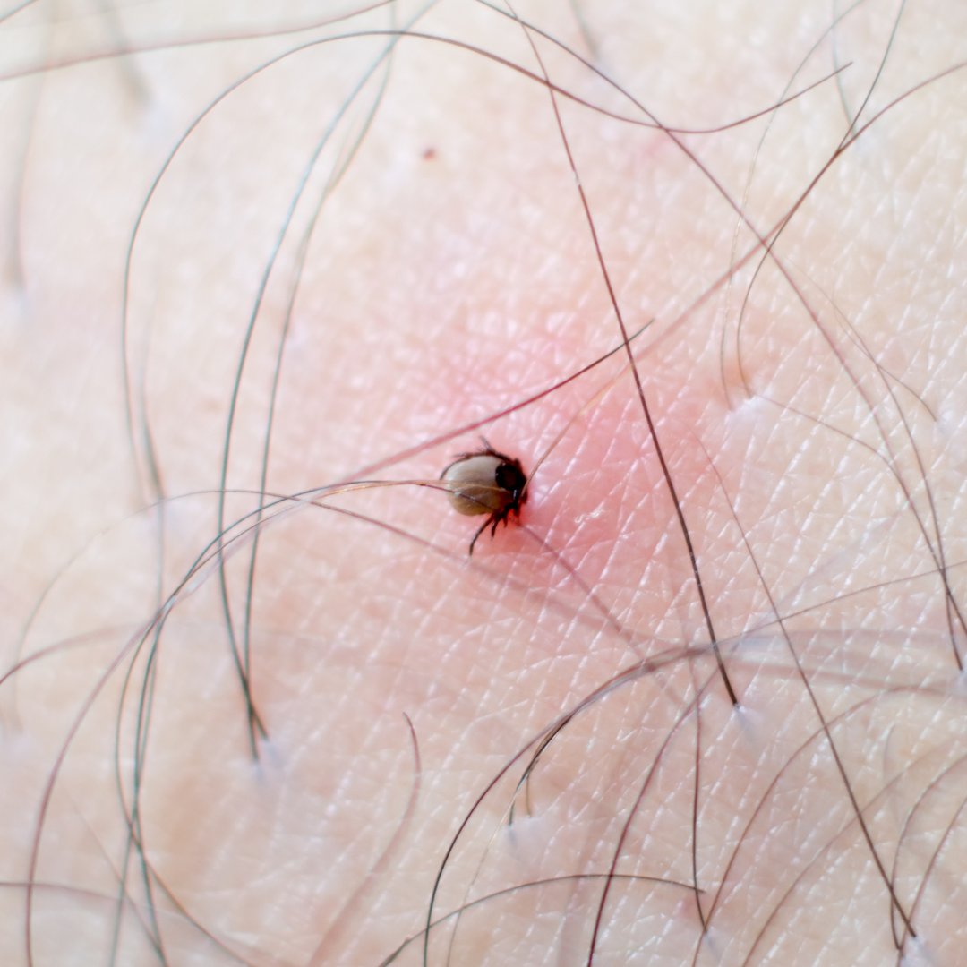 🐜 Ticks can be as small as a poppy seed, making them difficult to spot, especially around the hairline which is where they are commonly found on children. There are a few simple steps you can take to reduce your chances of being bitten by a tick 👇 lymediseaseuk.com/prevention/