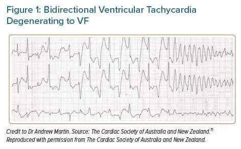 💥Catecholaminergic Polymorphic Ventricular Tachycardia

aerjournal.com/articles/catec…
#ePeeps #CardioTwitter #CardioEd #CPVT