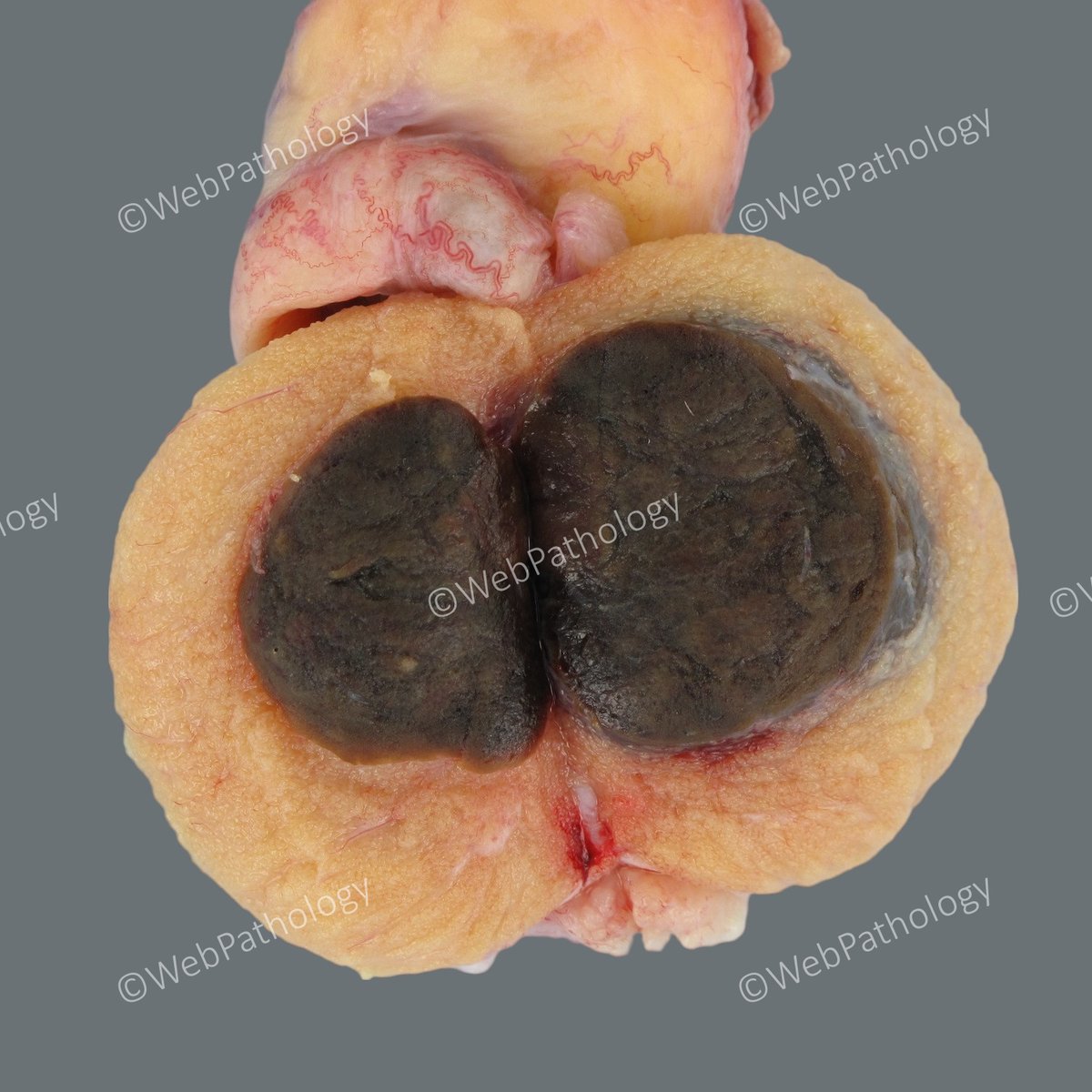 Testicular Neoplasms. Case 2: Adult male (> 35 yrs) with a testicular mass. Any guesses based on macroscopic appearance? Clinical info. and labs. to follow soon. #PathTwitter #PathResidents #GUPath