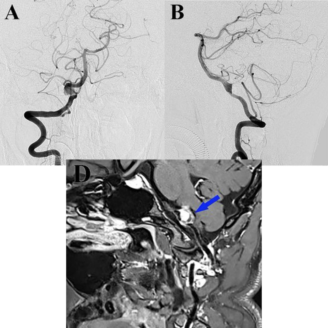 🔍 New Study Unveils Promising Insights into Intracranial Dissecting Aneurysm Treatment! 🧠💉
✨ Key Results:
• 89.7% favorable functional outcome
• 71.7% complete occlusion rate
• 99.1% technical success rate
Read <a href="/JNIS_BMJ/">JNIS</a> bit.ly/3SjiFrZ
<a href="/dramirhni/">Amir Hassankhani</a>