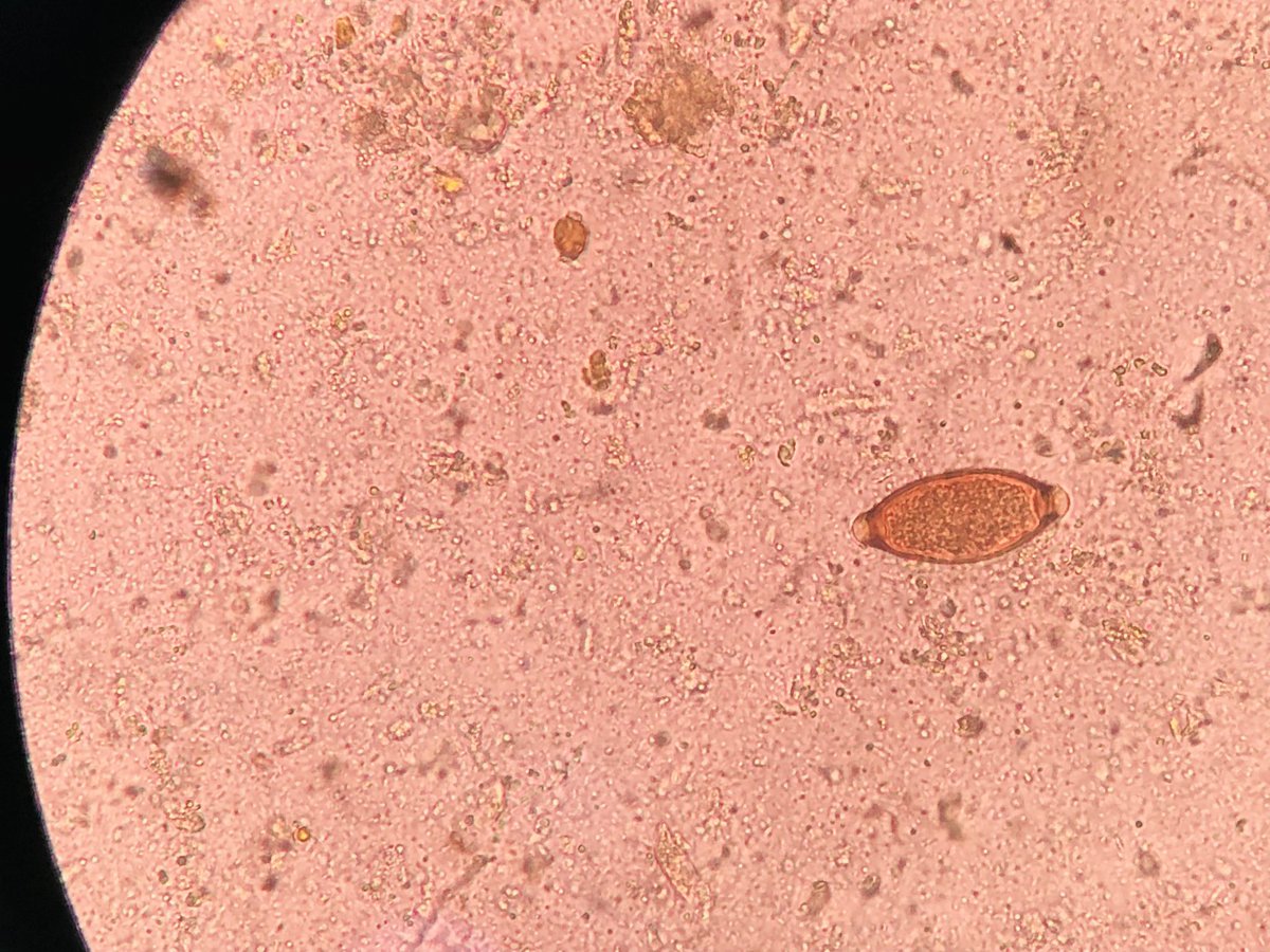 Zeeiny3's tweet image. Finally saw a clear microscopy view of  Trichuris trichiura (Whipworm) in a stool sample👏🏾this looks so clear
#MLScommunity