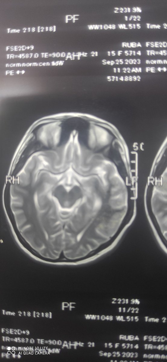 AlimuslimL's tweet photo. Needs Opinion
A 16 years girl presented with progressive gait difficulty only

MRI Brain reported as Wilson disease. Her Slit lamp examination Normal her Ceruloplasmin and urinary copper levels normal https://t.co/mFsfsgh3NU