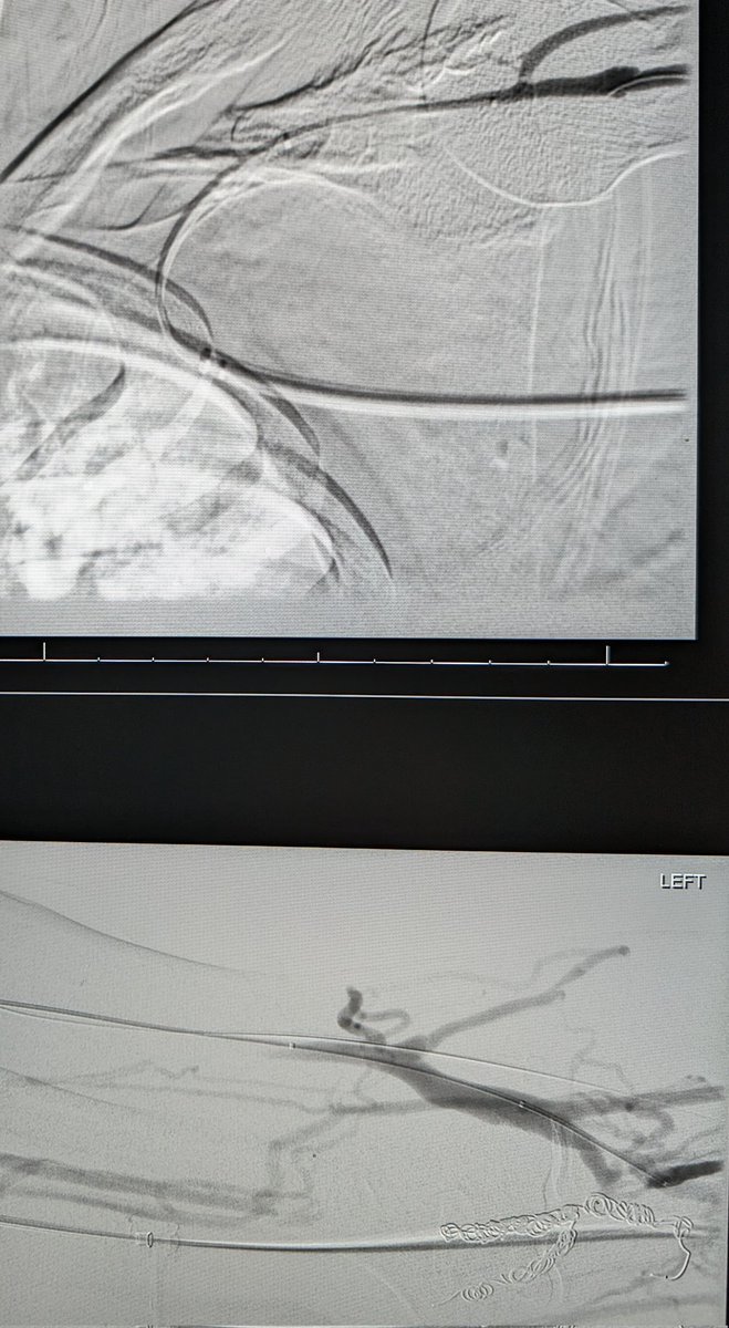LessneVIR's tweet photo. #Ellipsys #pAVF w cephalic vein CTO
Can't cross antegrade--> so retro cross it is!
Covered stent still going strong almost 2 yrs later. Needs a little #DCB touch up.
#IRad @robshahverdyan @CHICKVIR @SIRspecialists @VascularSVS @wasse_m @YuoTheodore @SaadTheodore @ajgunnmd https://t.co/mR7YO5uX0H