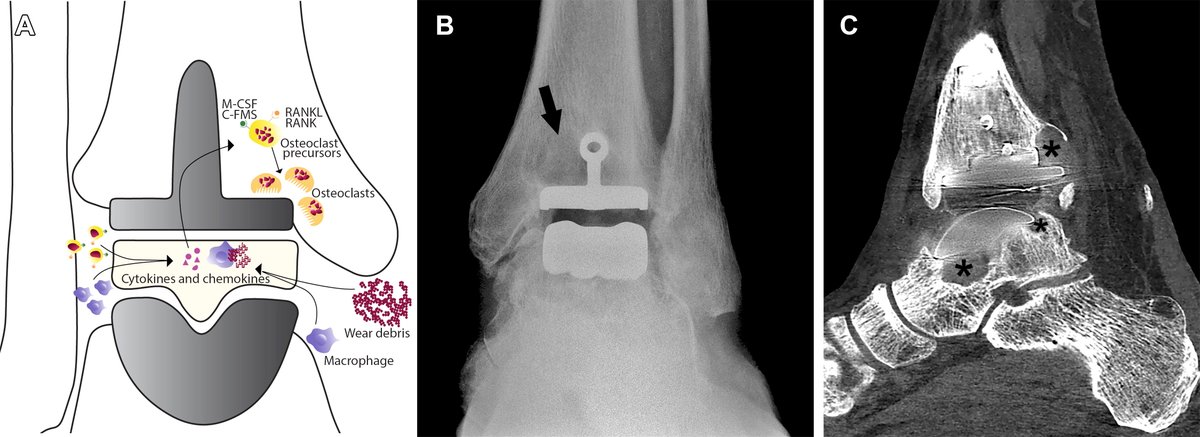 Total ankle replacement (TAR) methods and devices have evolved tremendously over the years. Radiologists should recognize the imaging appearances of well-functioning TARs vs those with complications to benefit the patient and the ankle surgeon. bit.ly/3Hc4Mpa