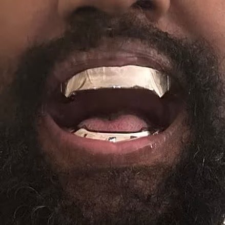 #ye has replaced his teeth with $850,000 dentures “The implant is a new surgical model and is unique to the musician - with the total cost rumored to be an eye-watering $850,000.” - dailymail