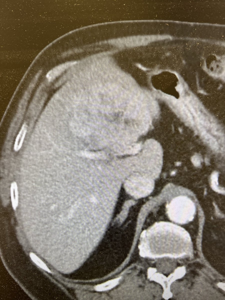 Csaba Gajdos MD, FACS, FSSO (@csabagajdos1) on Twitter photo Central hepatectomy for HCC with biliary and portal bifurcation exposed on top left picture, co-surgery Dr Zaaroura, <a href="/Jacobs_Med_UB/">Jacobs School at University at Buffalo</a> <a href="/UBSurgery/">Department of Surgery | University at Buffalo</a> <a href="/UABSurgery/">UAB Surgery</a> <a href="/UMichSurgery/">Michigan Surgery</a> Central hepatectomy for HCC with biliary and portal bifurcation exposed on top left picture, co-surgery Dr Zaaroura, <a href="/Jacobs_Med_UB/">Jacobs School at University at Buffalo</a> <a href="/UBSurgery/">Department of Surgery | University at Buffalo</a> <a href="/UABSurgery/">UAB Surgery</a> <a href="/UMichSurgery/">Michigan Surgery</a>