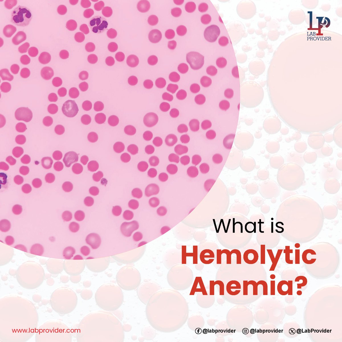 #Hemolyticanemia is a condition in which #redbloodcells are destroyed more quickly than they can be produced. The destruction of red blood cells is known as #hemolysis.

It can be #inherited and #acquired.