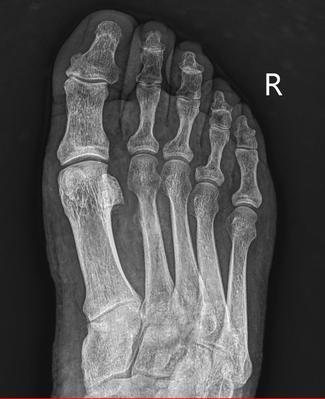 18/1/2024. 🚨 60yo male dealing with instep pain! 🦶💔 #Foot Got his AP #XRAY revealing a diagnosis that's easy to miss! Confirmed in lateral oblique. Any guesses? 🤔 Drop your thoughts below! 👇#traumatwitter