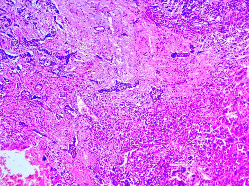 #BreastPath curiosity : Biphasic mixed metaplastic breast carcinoma

✌🏻Biphasic : 
⭕IDC, NST component
⭕Multiple metapl. components :
✅Squamous
✅Spindle
✅Chondroid

#pathology #pathX #pathTwitter #pathresidents