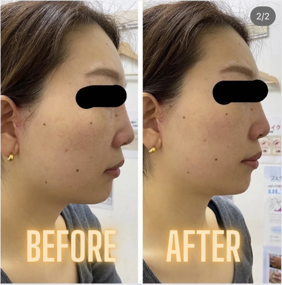 ClairClinic's tweet photo. リアルなお声と共に当院の症例をご紹介していきたいと思います☺️✨
・
🌷30代前半　女性
・
🌷頬＋顎下 300ショット
・
🌷LINEお友達価格￥49,500

＃ハイフ　＃リフトアップ　＃頬のたるみ　＃ほうれい線 https://t.co/utLISrJb6S