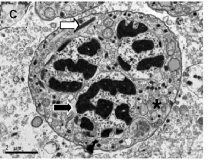 Hematodinium is a dinoflagellate that blooms IN the blood of marine crustacean hosts like Nephrops. It may well be the most significant pathogen in the global crustacean fishery and also found in aquaculture🦞🦀 🦐 New paper on 3 decades of UK data👇 royalsocietypublishing.org/doi/10.1098/rs…