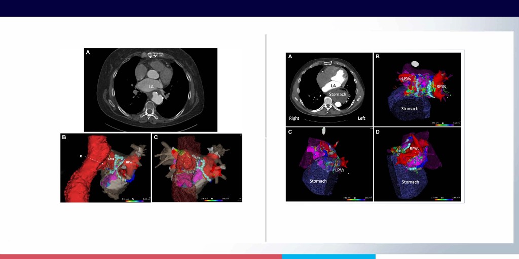 3 great cases showcasing the innovative use of Galvanize’s CENTAURI focal #PFA generator to safely ablate arrhythmias in complex anatomies unsuited for standard ablation. ow.ly/WMTJ50QrYo3 ow.ly/9wfB50QrYo2 CENTAURI is not available for sale in the US.