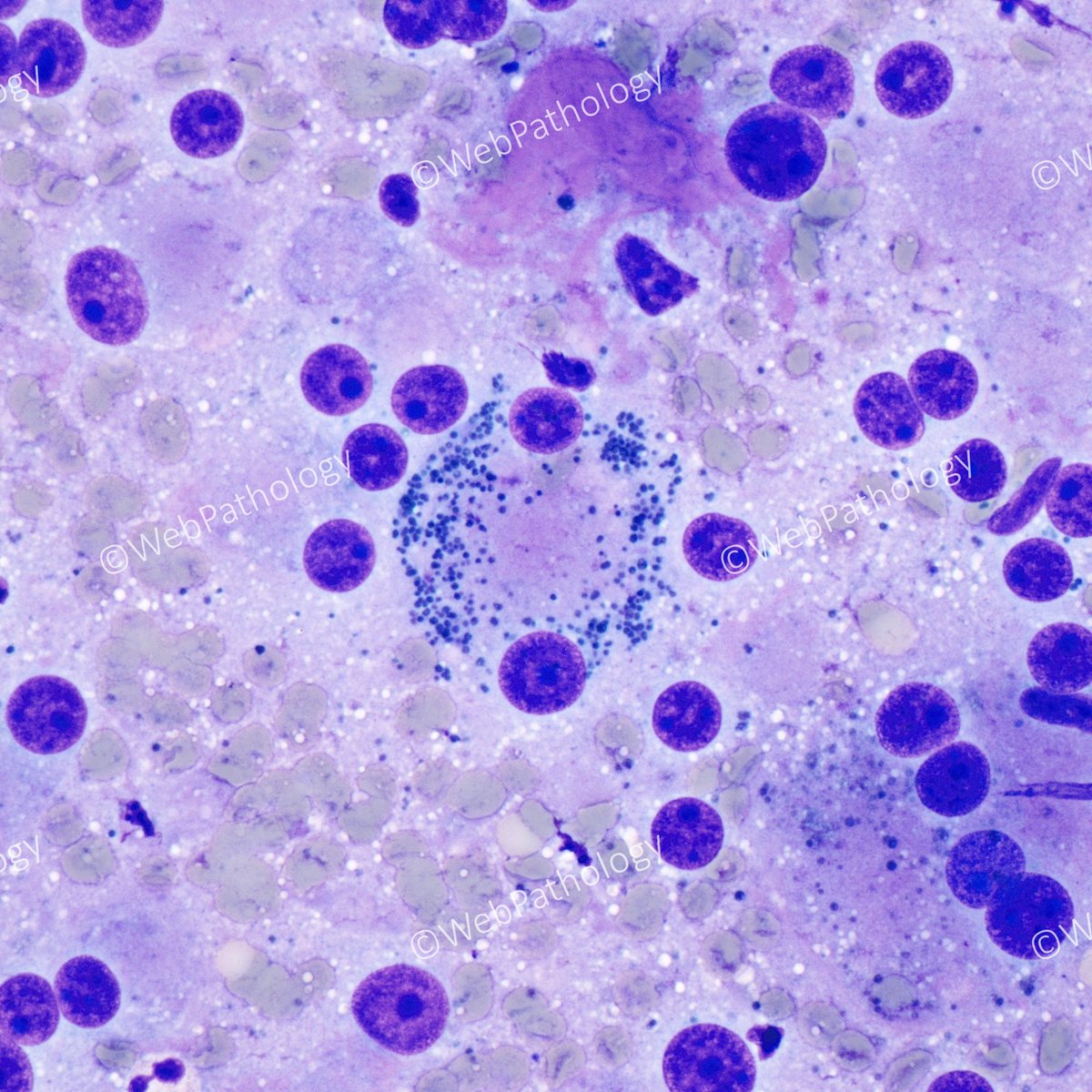 Adult male with infertility, azoospermia, elevated testosterone & testicular mass. Tumor markers (AFP, LDH, hCG) within ref. range. Diagnosis: Leydig Cell Tumor. Dark color due to lipofuscin (seen in 15% cases). Last image - Diff-Quik stained touchprep. #GUPath #PathTwitter