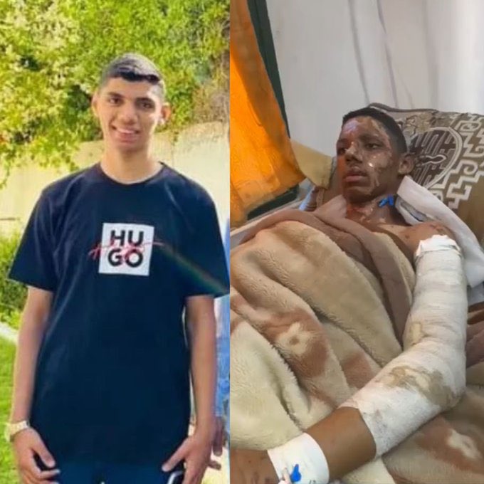 لا تنسوا عمرو ، لسا عمرو ما طلع وما تعالج ، كل دقيقة مهمة حتى يطلع عمرو ويتعالج.
 
عمرو رح يخسر ايده لو ما طلع يتعالج 
عمرو جسمه في حروق بنسبة ٤٥٪ وفي بلاتين برجله.
عمرو بيستحق حياة سليمة.

#علاج_عمرو_ابو_قاسم