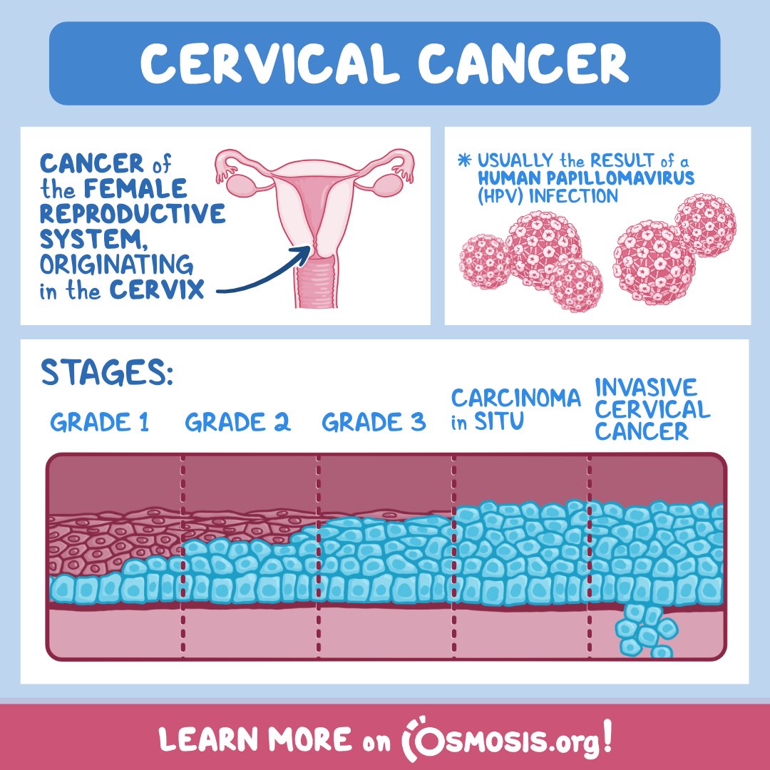 In support of #CervicalHealthAwarenessMonth, today's Pathology Review is about cervical cancer, one of the most common cancers in patients assigned female at birth. It’s usually the result of an infection by the human papillomavirus (HPV).

Learn more: osms.it/path-cervical-…