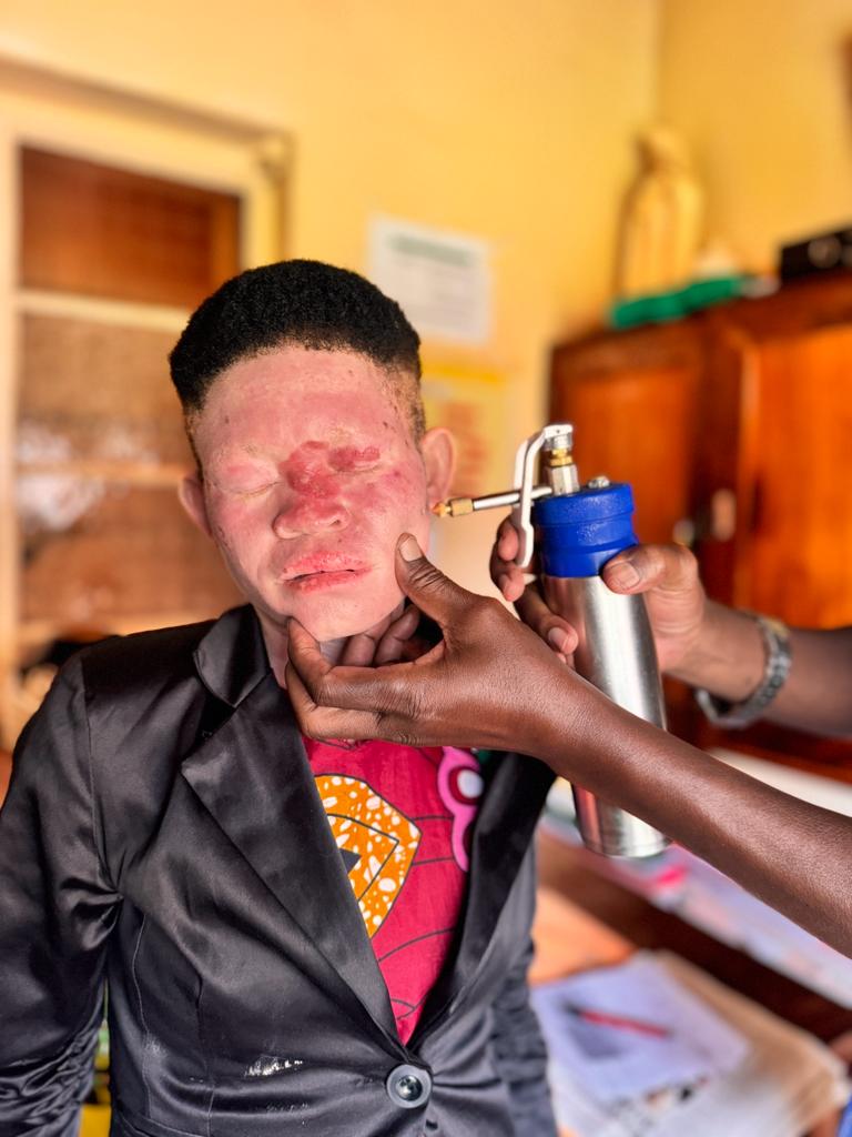 The sunrays have adverse effects on persons with albinism.  On top of accessing dermatology services,  it's important for persons with albinism to adopt appropriate sunprotection behaviors. 
#SNUPA 
#EFPA
