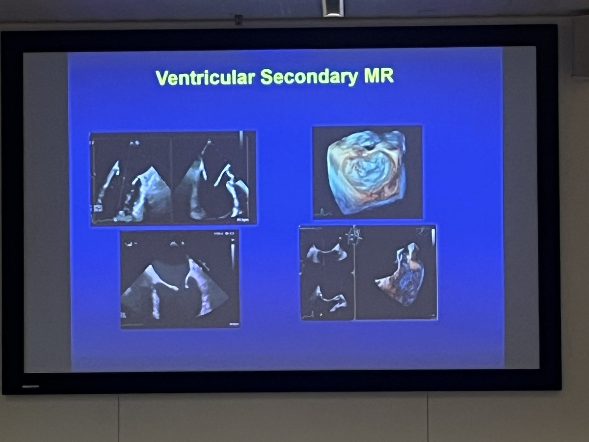Victoria Delgado (@vdelgadogarcia) on Twitter photo The 3D #EchoMTE course just started
🫀importance of 3D volumes
🫀3D assessment of heart valves
<a href="/NAjmoneMarsan/">Nina Ajmone Marsan</a> <a href="/ElenaSurkova9/">Elena Surkova</a> <a href="/DrHaniMahmoud/">Hani Mahmoud-Elsayed</a> <a href="/Doc_Niro/">Lorenzo Niro</a> @IcorCat <a href="/MartinaRaffele/">Martina De Raffele</a> <a href="/EFerrerSistach/">Elena Ferrer Sistach</a> <a href="/EACVIPresident/">EACVI President</a> <a href="/victoria_vilata/">Victoria Vilalta</a> <a href="/CHPedroLi/">CH. Pedro Li</a> The 3D #EchoMTE course just started
🫀importance of 3D volumes
🫀3D assessment of heart valves
<a href="/NAjmoneMarsan/">Nina Ajmone Marsan</a> <a href="/ElenaSurkova9/">Elena Surkova</a> <a href="/DrHaniMahmoud/">Hani Mahmoud-Elsayed</a> <a href="/Doc_Niro/">Lorenzo Niro</a> @IcorCat <a href="/MartinaRaffele/">Martina De Raffele</a> <a href="/EFerrerSistach/">Elena Ferrer Sistach</a> <a href="/EACVIPresident/">EACVI President</a> <a href="/victoria_vilata/">Victoria Vilalta</a> <a href="/CHPedroLi/">CH. Pedro Li</a>