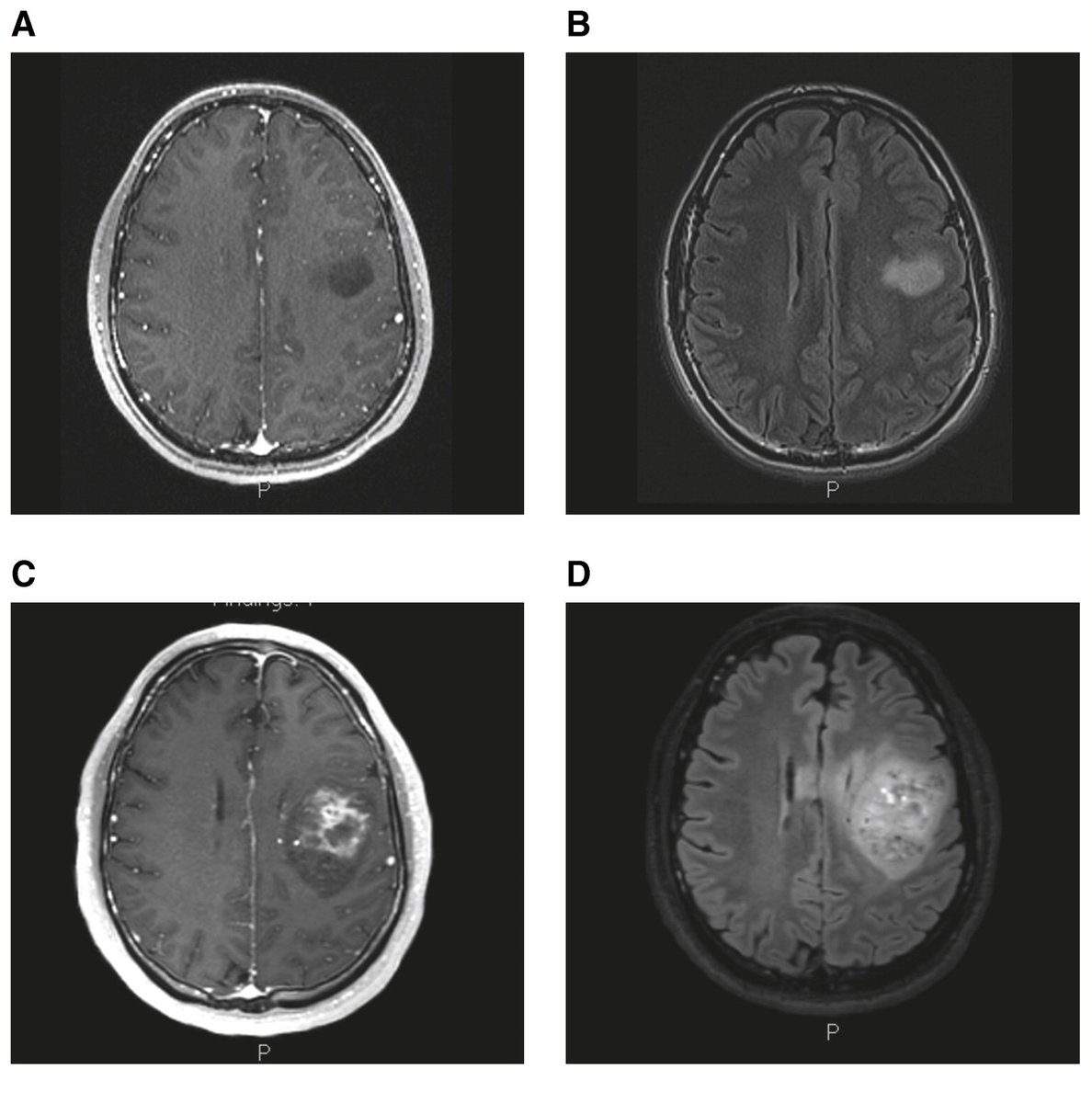 Central nervous system tumors are common in adolescents and young adults (AYAs). A @JCO_ASCO review by Dr. Jing Wu, @DrHeidelberg, and @DrAmarGajjar discussed diagnostic approaches and management strategies for tumors that commonly occur in AYAs: go.cancer.gov/UK8upEK