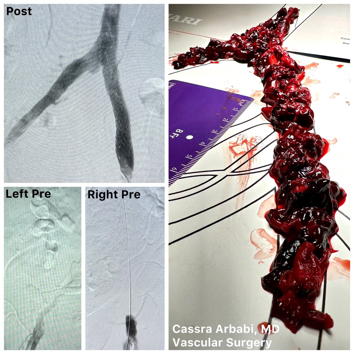 Acute IVC/BL iliofem #DVT. Has non retrievable IVCF for 30+ yrs. Not on AC. Treated w both flowtriever+clottriever, followed by kissing stents, massive clot burden removed. Doing well several months post op. Tiny chronic residual clot in IVCF, now on AC. #vascular @kevinsealsmd