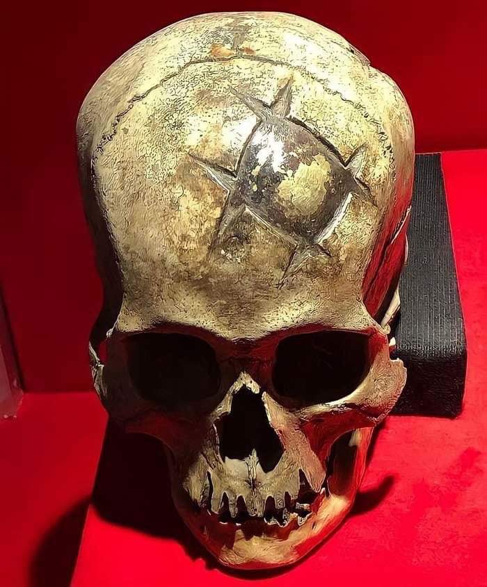 archeohistories's tweet photo. The act of scraping, cutting, or drilling an opening into cranium was practiced around the world, primarily to treat head trauma, but possibly to quell headaches, seizures and mental illnesses, or even to expel perceived demons. According to a new study led by the University of Miami Miller School of Medicine's David S. Kushner, M.D., clinical professor of physical medicine and rehabilitation, trepanation was so expertly practiced in ancient Peru that the survival rate for the procedure during Incan Empire was about twice that of American Civil War - when, more three centuries later, soldiers were trepanned presumably by better trained, educated and equipped surgeons.

"There are still many unknowns about procedure and individuals on whom trepanation was performed, but outcomes during Civil War were dismal compared to Incan times," said Kushner, a neurologist who has helped scores of patients recover from modern-day traumatic brain injuries and cranial surgeries. "In Incan times, mortality rate was between 17-25%, and during Civil War, it was between 46-56%; that's a big difference.

Ancient Peruvians had plenty of practice. More than 800 prehistoric skulls with evidence of trepanation - at least one but as many as seven telltale holes - have been found in the coastal regions and Andean highlands of Peru, earliest dating back to about 400 BC. That's more than combined total number of prehistoric trepanned skulls found in the rest of the world. Which is why Verano devoted an entire book, Holes in the Head - The Art and Archeology of Trepanation in Ancient Peru, to the 800-plus skulls, most of which were collected from burial caves and archaeological digs in the late 1800s and early 1900s and reside in museums and private collections today.

The book analyzes techniques and survival rates of trepanation in Peru through demise of Incan Empire in early 1500s. Researchers gauged survival by classifying extent of bone remodeling around trepanned holes, which indicates healing. If there was no evidence of healing researchers assumed patient died during or within days of the surgery. If margins of trepanation openings showed extensive remodeling, they considered operation successful and patient long-lived.

World Neurosurgery Paper, reports how ancient Peruvians significantly refined their trepanation techniques over the centuries. They learned, for example, not to perforate protective membrane surrounding brain - a guideline Hippocrates codified in ancient Greece at about same time, 5th Century BC, that trepanning is thought to have begun in ancient Peru. Long-term survival rates from such "shallow surgeries" in Peru during those early years, from 400-200 BC, proved to be worse than those in Civil War, when about half patients died. From 1000-1400 AD, survival rates improved dramatically, to as high as 91% in some samples, to an average of 75-%83 during Incan period. 

Over time, from earliest to present, they seemed to understand head anatomy and purposefully avoided the areas where there would be more bleeding. They also realized that larger-sized trepanations were less likely to be as successful as smaller ones. Physical evidence definitely shows that these ancient surgeons refined the procedure over time. Their success is truly remarkable. By the end of WWI, cranial surgery evolved into distinct profession of neurosurgery, which continues to improve our understanding of brain anatomy, physiology and pathology. As today's neurosurgeons regularly cut into brain to remove tumors and blood clots, reduce intracranial pressure from massive strokes and trauma, repair vascular and structural anomalies and treat a myriad of other complex problems with great success. Today, neurosurgical mortality rates are very, very low; there is always a risk but likelihood of a good outcome is very high, just like in ancient Peru.

📷 : Early Incan Cranioplasty done with gold inlay whish is well healed. (Museum of Gold, Lima, Peru)

#archaeohistories
