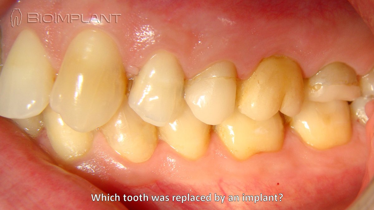 BioImplant (@bioimplant) on Twitter photo 