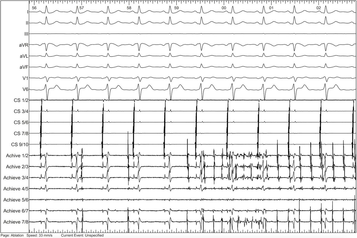 Thomas Beiert (@tbeiert) on Twitter photo Found a gem from the archives. Achieve in LSPV during CB PVI shortly after isolation. Always nice to see such rapid PV-firing.
What is your favourite moment in EP?
<a href="/Phiso_de/">Philipp Sommer</a> <a href="/Mel_Gunawardene/">Melanie Gunawardene</a> <a href="/ChristianHeeger/">Christian-H. Heeger</a> <a href="/DrV_Mann/">Christian Veltmann</a> <a href="/AndreasZietzer/">Andreas Zietzer</a> <a href="/javadm20/">javad mikaeili</a> <a href="/syamkumarmd/">Syamkumar</a> <a href="/veramasloo/">Vera Maslova</a> <a href="/AGEP_DGK/">AGEP</a> Found a gem from the archives. Achieve in LSPV during CB PVI shortly after isolation. Always nice to see such rapid PV-firing.
What is your favourite moment in EP?
<a href="/Phiso_de/">Philipp Sommer</a> <a href="/Mel_Gunawardene/">Melanie Gunawardene</a> <a href="/ChristianHeeger/">Christian-H. Heeger</a> <a href="/DrV_Mann/">Christian Veltmann</a> <a href="/AndreasZietzer/">Andreas Zietzer</a> <a href="/javadm20/">javad mikaeili</a> <a href="/syamkumarmd/">Syamkumar</a> <a href="/veramasloo/">Vera Maslova</a> <a href="/AGEP_DGK/">AGEP</a>