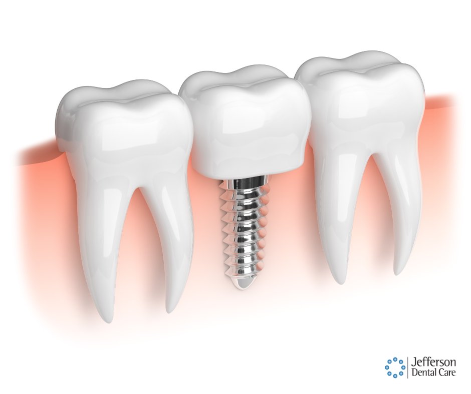 Do you have one or more missing teeth?
We can help!--> bit.ly/3S7YewX

#JeffersonDentalCare #dentalimplants #SmileRestoration