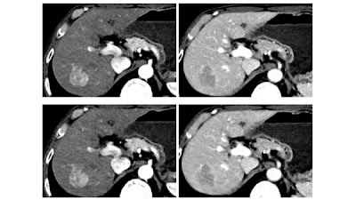 Radiology: Artificial Intelligence (@radiology_ai) on Twitter photo Compared with standard-dose liver CT, low-dose liver CT with #DeepLearning reconstruction reduced image noise doi.org/10.1148/ryai.2⦠<a href="/SNU_Rad/">SNU Radiology</a> <a href="/snuh_official/">Seoul National University Hospital</a> #AbdRad #radiology #MachineLearning Compared with standard-dose liver CT, low-dose liver CT with #DeepLearning reconstruction reduced image noise doi.org/10.1148/ryai.2⦠<a href="/SNU_Rad/">SNU Radiology</a> <a href="/snuh_official/">Seoul National University Hospital</a> #AbdRad #radiology #MachineLearning