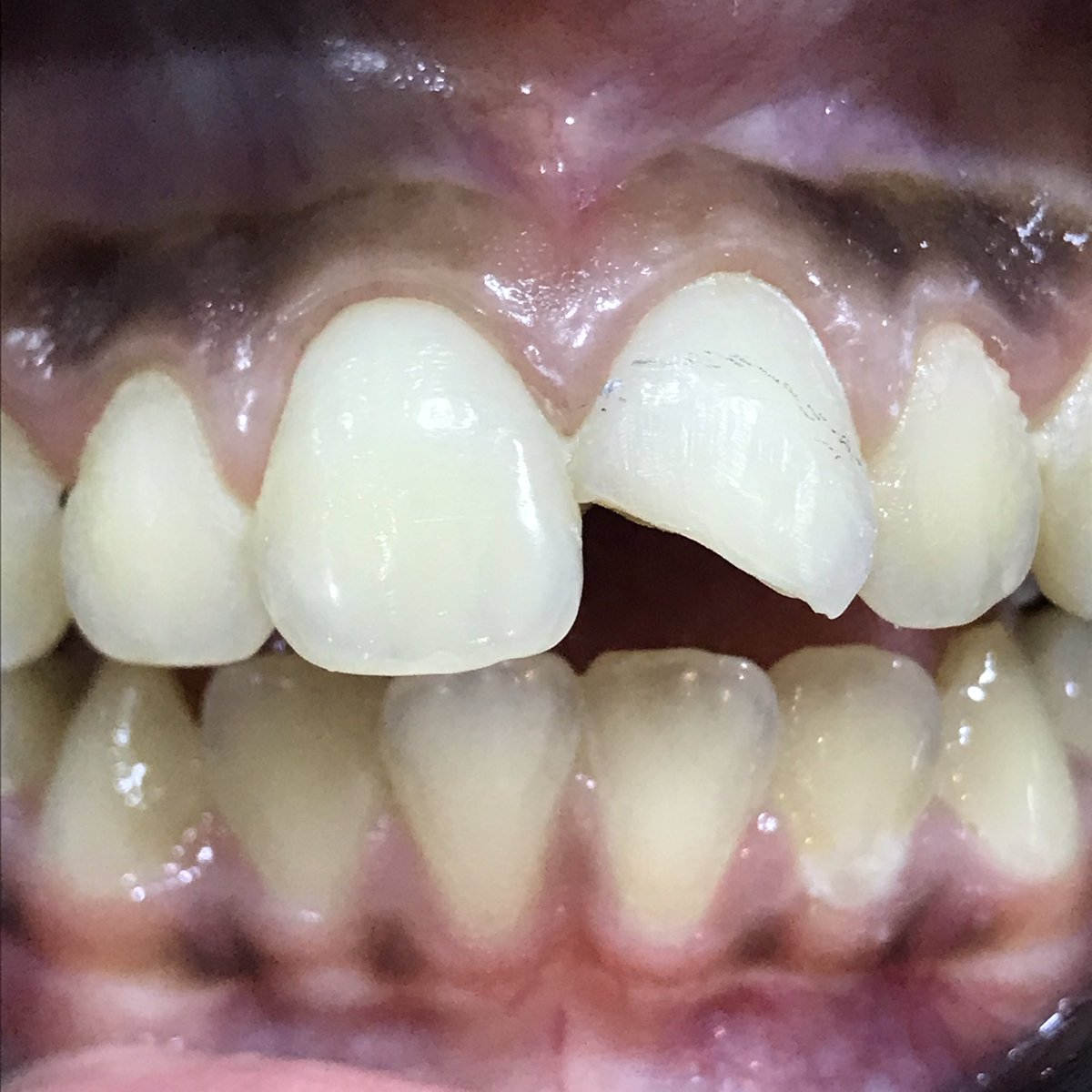 MegZhatem's tweet photo. متّع عينك 🔥♥️

ذلك من فضل الله علينا.

Composite restoration
حشو تجميلي https://t.co/nulfJdDss7