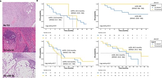 OncJournal's tweet photo. In the #KENDO trial, there was no benefit from using 1L/2L #chemo vs #CDKinhibitor + endocrine therapy in chemo-naïve patients with aggressive HR+/HER2– metastatic #BreastCancer. #bcsm @FrancescoSche20 @hospitalclinic @UgoDeGiorgi @IRSTDinoAmadori
https://t.co/okxRYuw4A7 https://t.co/upb2cMB2se