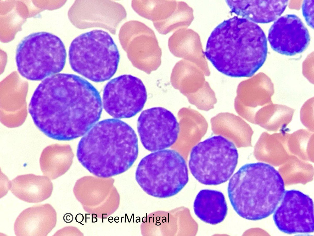 Leucemia Linfoide Aguda de Precursores B 🔬 Extendido de sangre periférica de una paciente femenina de 14 años. 🩸 -Tinción de Wright, 100x 🔬 #Hematologia #laboratorio #microscopy #Clinico #leucemia #casosclinicos #hematology