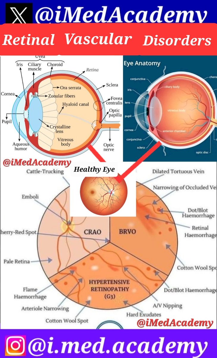NEETPG2026's tweet photo. Retinal Vascular Disorders:
CRAO, BRVO, Cotton wool spot.
#MBBS #FMGE #INICET #NEETPG
#neetpgrevision #MED #MedExam
#Doctors #iMedAcademy #Exams #MedTwitter #MedX #MedEd #Ed https://t.co/maUDZbqBCr
