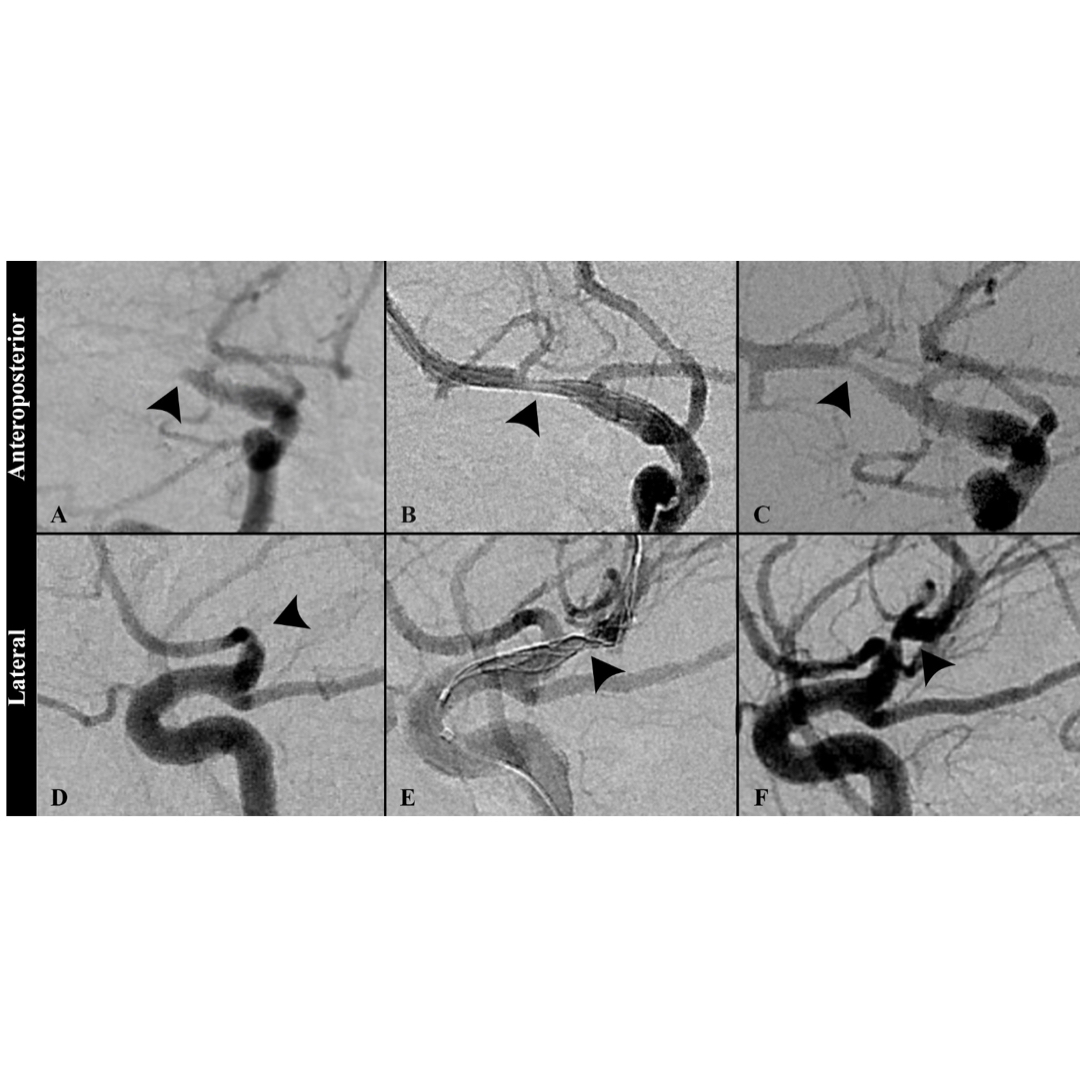 🧠 Don’t miss Laetitia de Villiers and @halrice discussing 4th gen #PED with Dr. Peter Kim Nelson and @esamaniego discussing Tigerretriever to treat AIS with underlying athero with @majidishahram. Along with @DrAltschul as part of @JNIS_BMJ journal club: 2/1 4-5PM EST