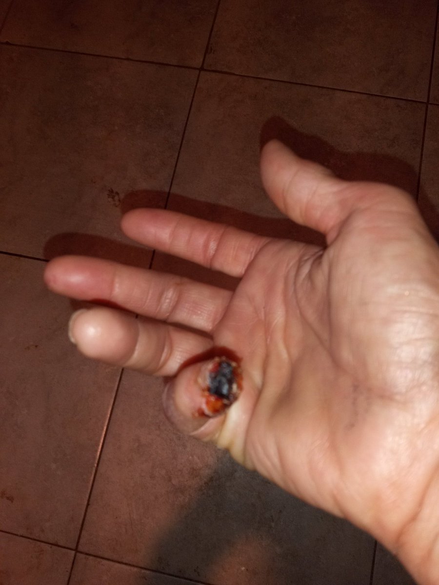 Hello friends

I'm asking for prayers. I ended up hospital, finger infected😭 res stripes were going up my arms.

I asked about skin graft. We are waiting on case worker. It hurts 😭
Really needing prayers🙏🙏🙏🙏🙏
I,❤️U ALL