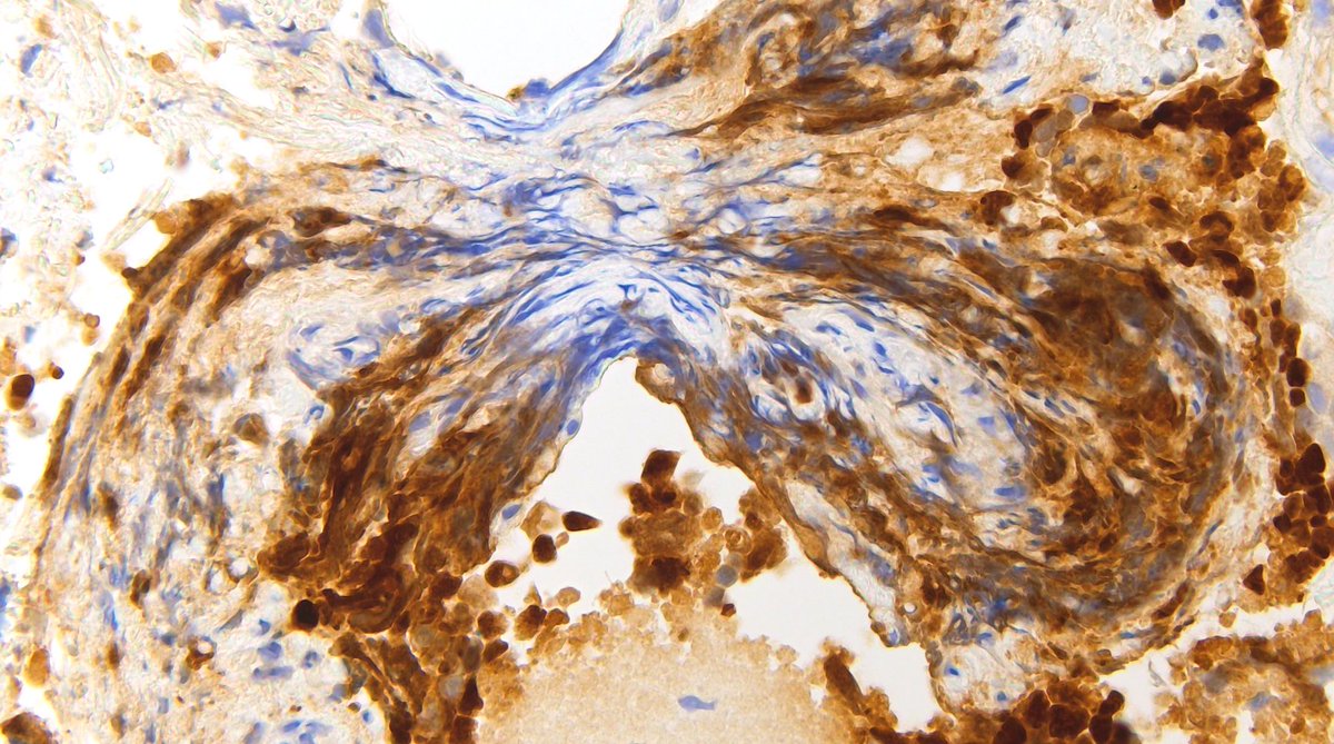 Big fan of INSM1 for small biopsies of small cell lung carcinoma because its so much easier to read when there is extensive crush artifact: #pathtwitter #surgpath #pulmpath