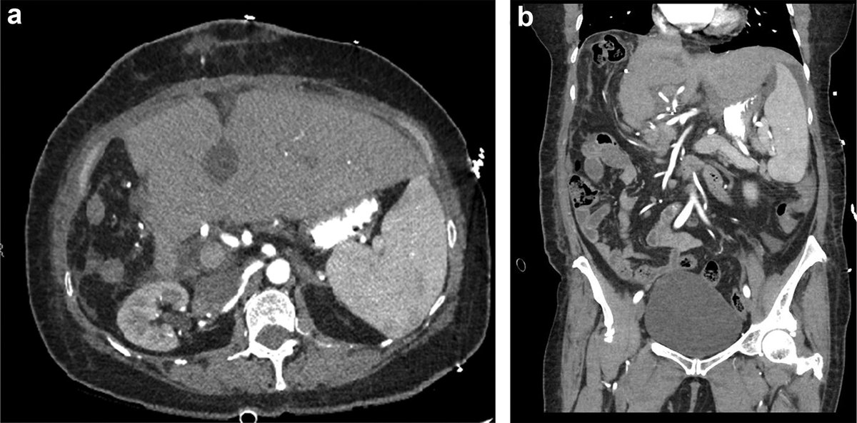 hswapnil's tweet photo. Another one 

What is this radioopaque material in the gut and why is it published in the @Kidney_Int ? 

Source https://t.co/aPoCvG8oYj https://t.co/aJ9W2N5mVN