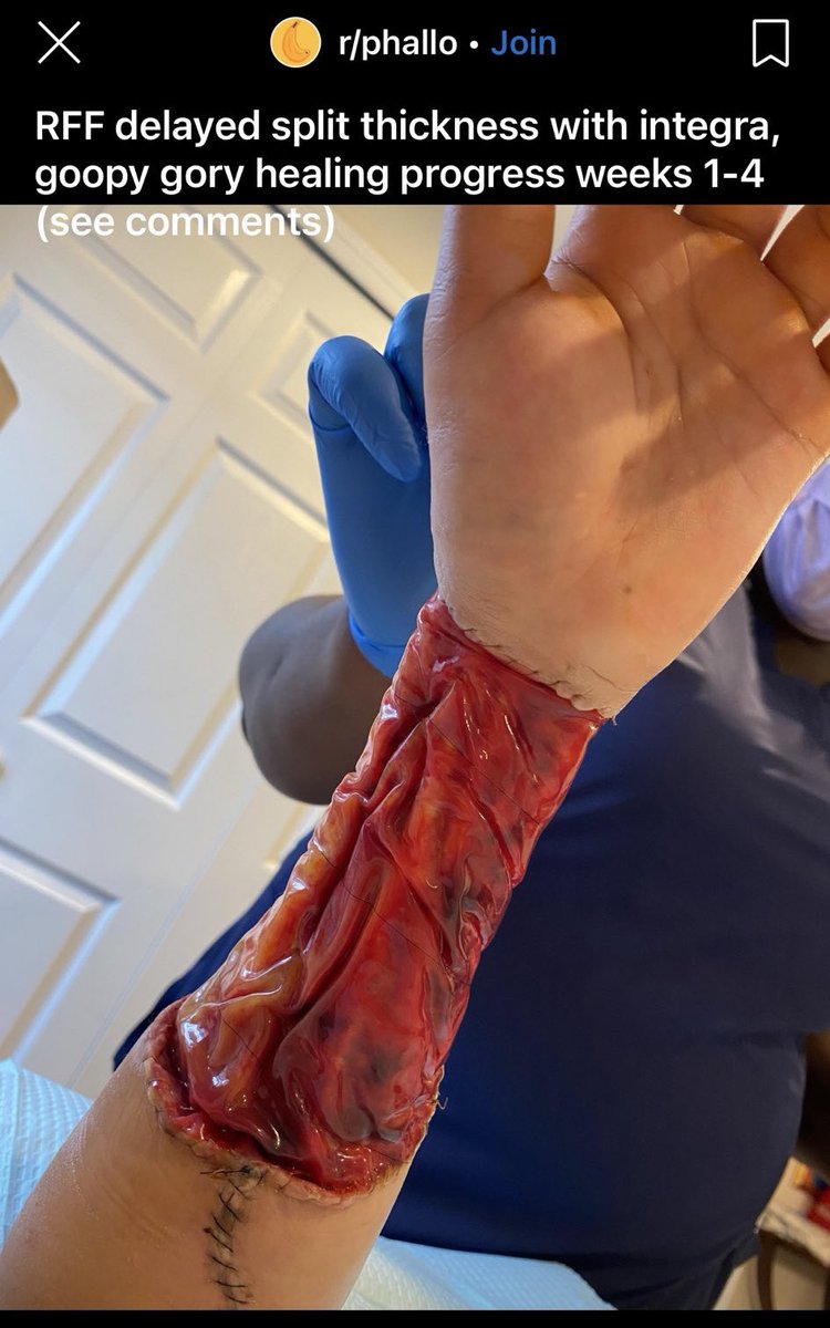 EXTREMELY GRAPHIC: Doctors did this to a healthy arm to cater to mental illness. A girl can decide she’s a boy and doctors will cut off part of her arm to make a fake p*nis. This is what the surgery looks like. The Left promotes this.