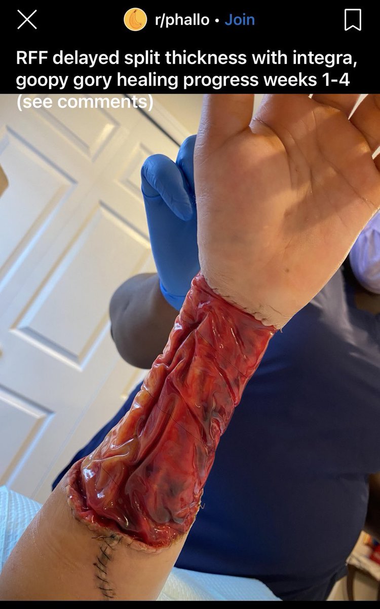 libsoftiktok's tweet image. EXTREMELY GRAPHIC: Doctors did this to a healthy arm to cater to mental illness. A girl can decide she’s a boy and doctors will cut off part of her arm to make a fake p*nis. This is what the surgery looks like. The Left promotes this.