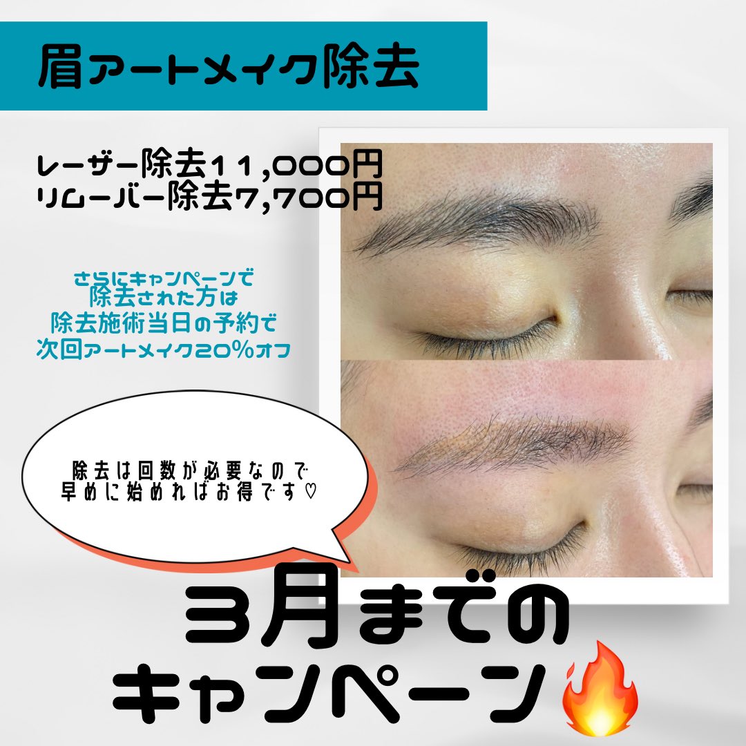 現在ｷｬﾝﾍﾟｰﾝまとめ💖 ◎肉割れアートメイク半額の22,000円 ◎たるみ