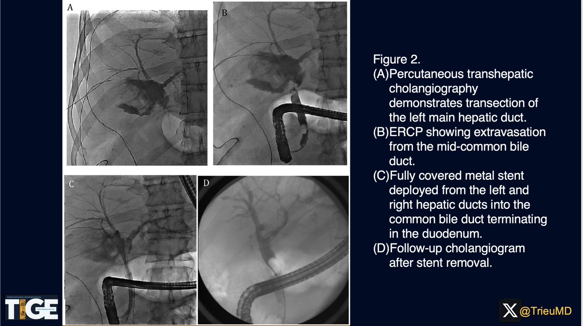 Judy Trieu, MD, MPH (@trieumd) on Twitter photo 👀<a href="/AGA_TIGE/">TIGE</a> #ICYMI👀
📰<a href="/ShyamTMD/">Shyam Thakkar, MD</a> & team describe 4 successful cases of endoscopic+IR management of completely transected common bile ducts. #MultidisciplinaryMedicine #MinimallyInvasive
🔎For more details: doi.org/10.1016/j.tige…
<a href="/ShailSingh/">Shailendra Singh</a> <a href="/yousafhadi/">Yousaf Hadi</a> 👀<a href="/AGA_TIGE/">TIGE</a> #ICYMI👀
📰<a href="/ShyamTMD/">Shyam Thakkar, MD</a> & team describe 4 successful cases of endoscopic+IR management of completely transected common bile ducts. #MultidisciplinaryMedicine #MinimallyInvasive
🔎For more details: doi.org/10.1016/j.tige…
<a href="/ShailSingh/">Shailendra Singh</a> <a href="/yousafhadi/">Yousaf Hadi</a>