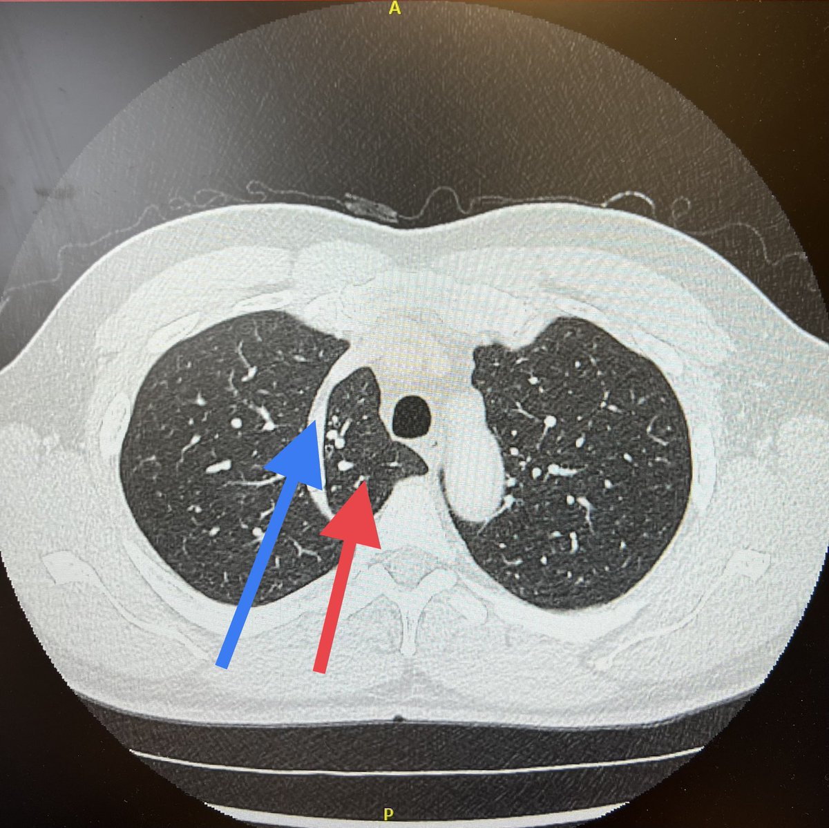 It’s been a while… But it’s Time for a new year of THORACIC THURSDAY!! 

Here you go…

-Name the structure the blue arrow is pointing to.
-Name the structure the red arrow is pointing to.
-What is the next step??

#thoracicthursday #anatomy #lung #thoracicsurgery #meded