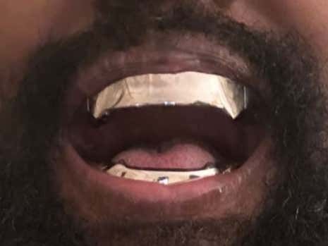 barstoolsports's tweet photo. Kanye West Has Removed All of His Teeth and Replaced Them With Titanium Dentures https://t.co/uxXttMVtvV https://t.co/f9BZbyGwOi