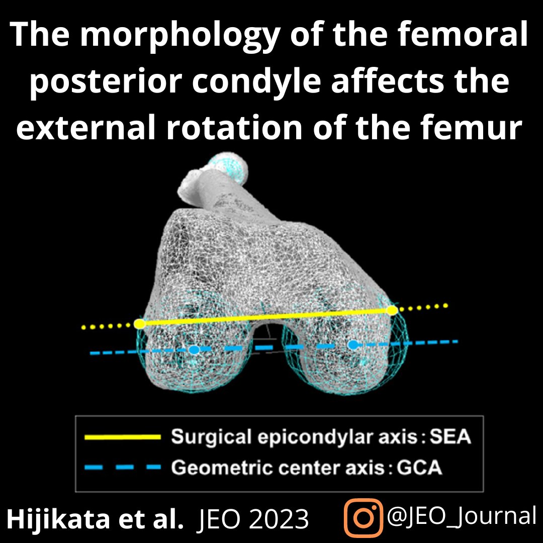 JEO_journal's tweet photo. This study identified several factors related to the external rotation of the femur during knee flexion.
Let's take a look at this OPEN ACCESS article: https://t.co/YFrqT0WnZQ
#femur #condyle #computedtomography #ct https://t.co/4yk20bDYFh