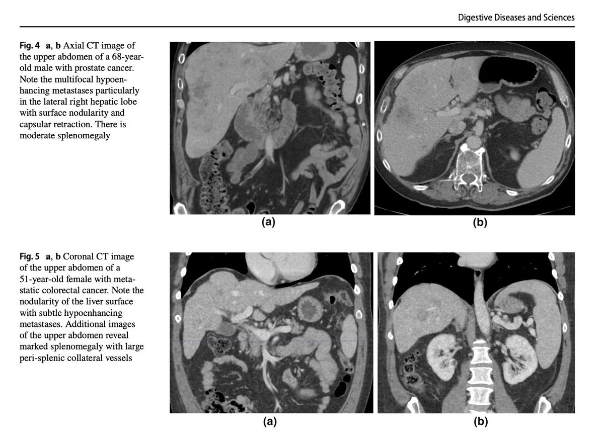 Never too late to get a paper published. This one from my last year of residency. Congrats to the rest of the team <a href="/RadiologyUSC/">Radiology of USC</a> <a href="/USC_KeckGILiver/">USC Division of GI & Liver</a> <a href="/USCRadiomics/">USC Radiomics Lab</a>